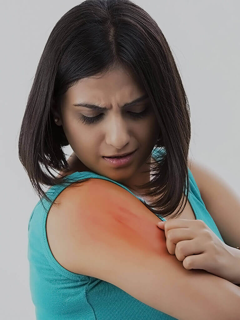 Skin Allergy
